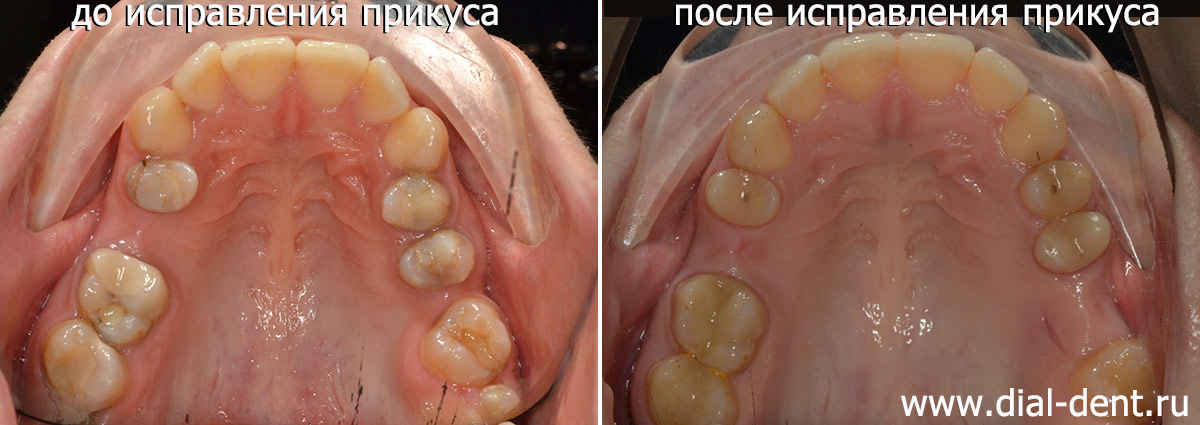 до и после исправления прикуса верхние зубы