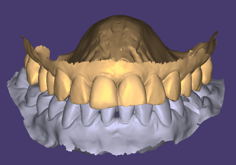моделирование зубных реставраций