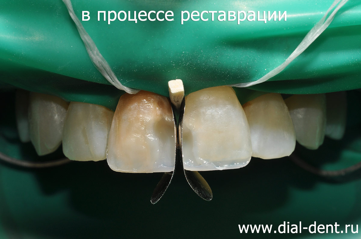 процесс реставрации передних зубов композитом