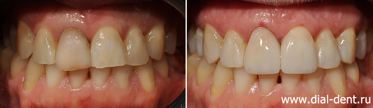 прямая реставрация передних зубов