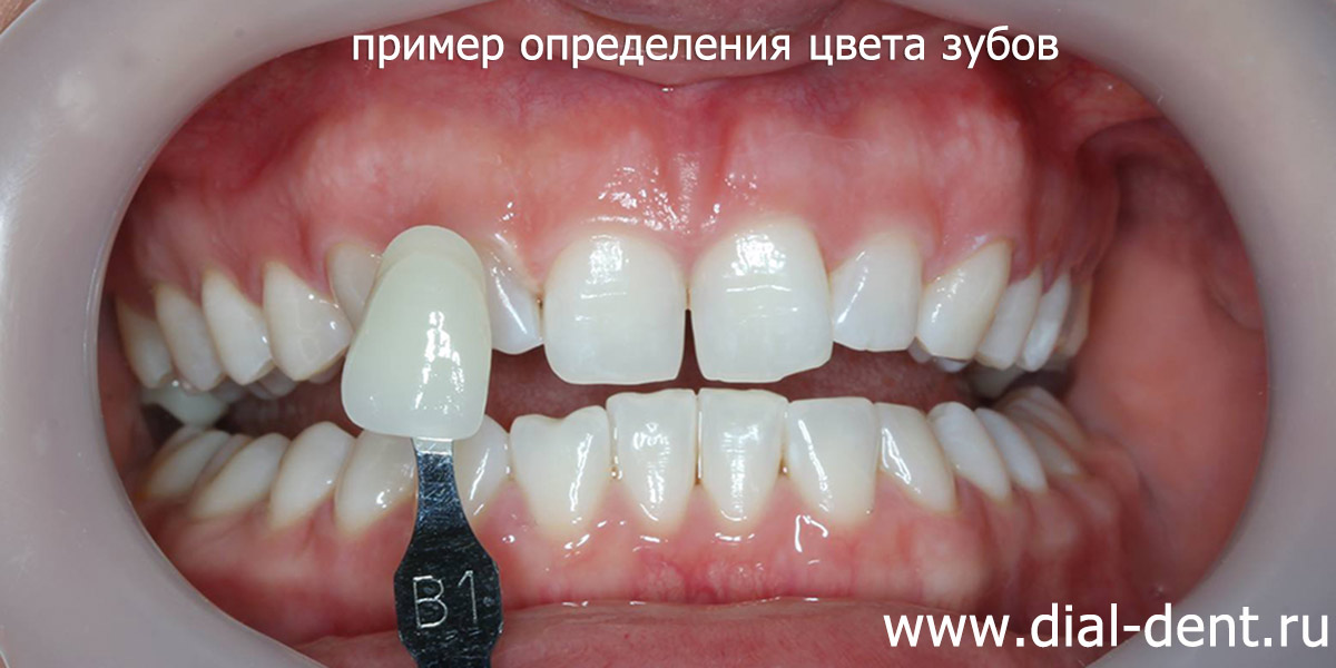 определение цвета зубов перед реставрацией