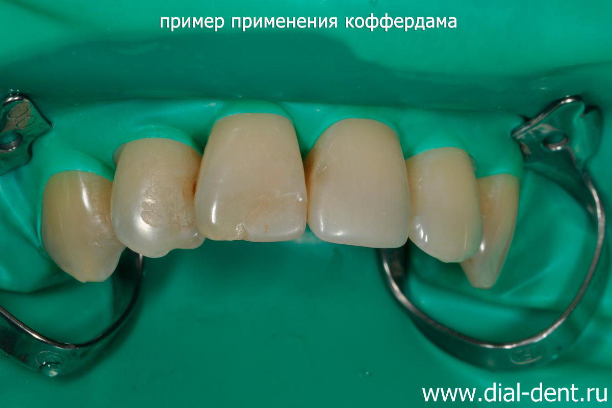 пример использования коффердама при реставрации передних зубов