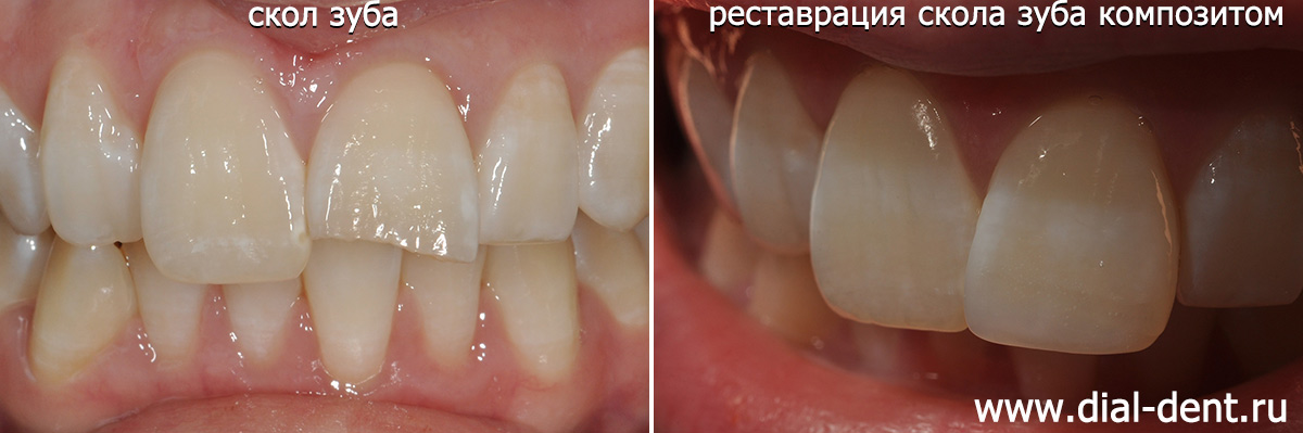 скол переднего зуба и результат реставрации скола
