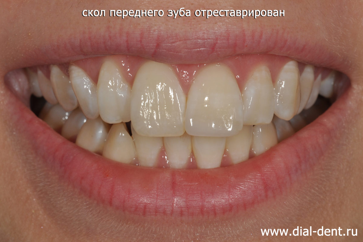 восстановлена эстетика улыбки после скола переднего зуба