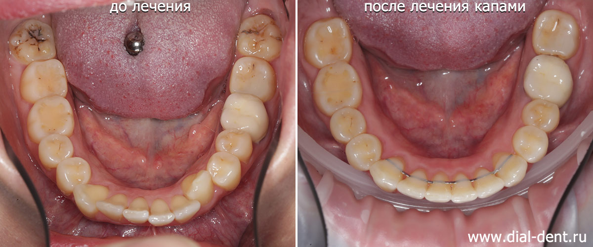 нижние зубы до и после ортодонтического лечения капами