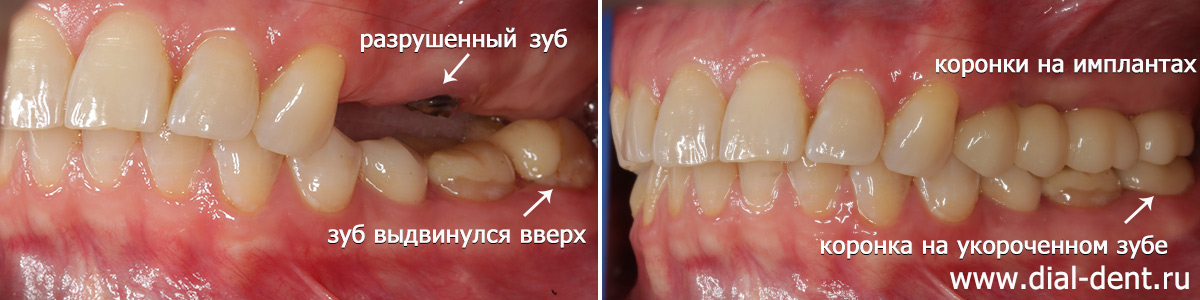 до и после удаления зуба, имплантации и протезирования