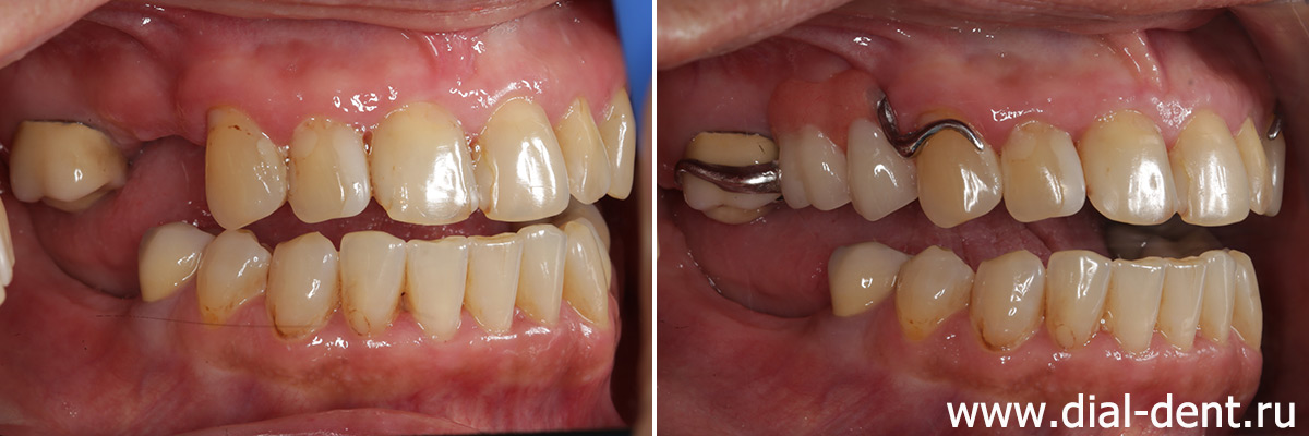 справа бюгельный протез на верхней челюсти замещает два зуба