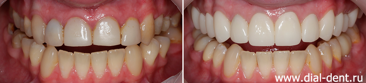 комплексное лечение с брекетами, имплантацией и протезированием зубов керамикой