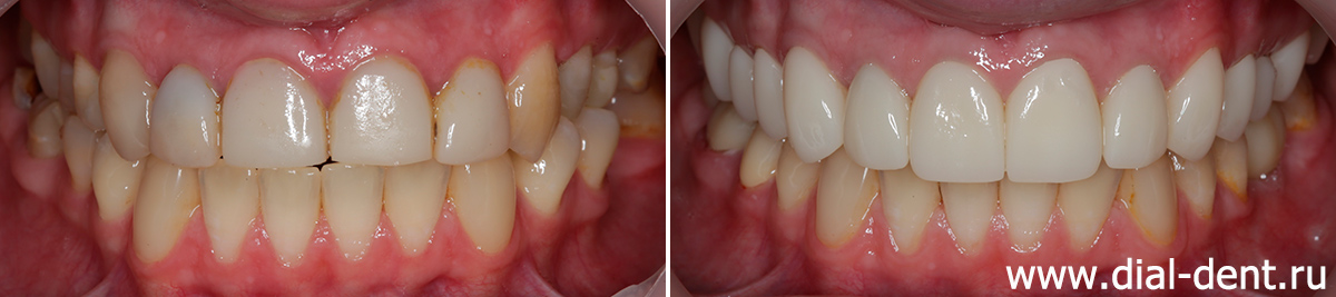 имплантация и протезирование зубов с ортодонтической подготовкой