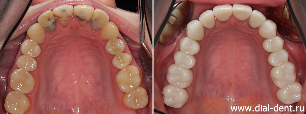 протезированием зубов керамикой в комплексном лечении