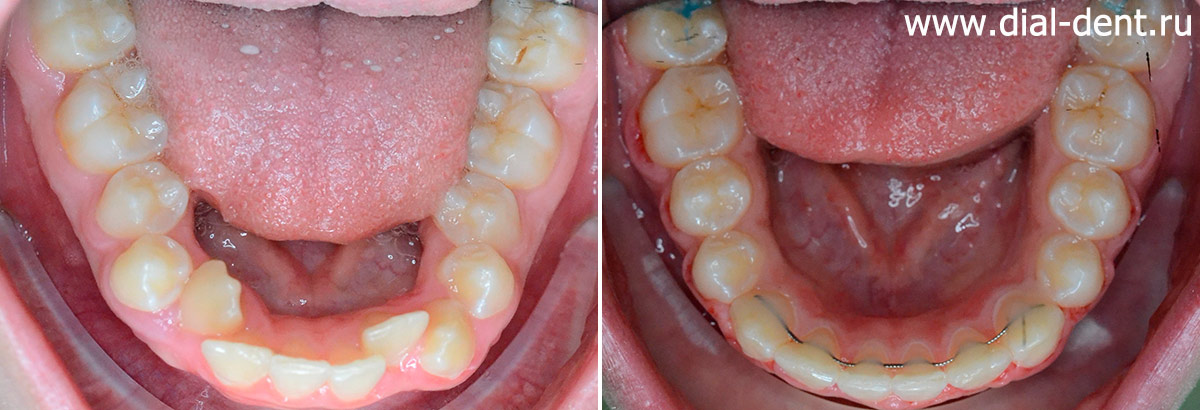 нижние зубы до и после исправления прикуса