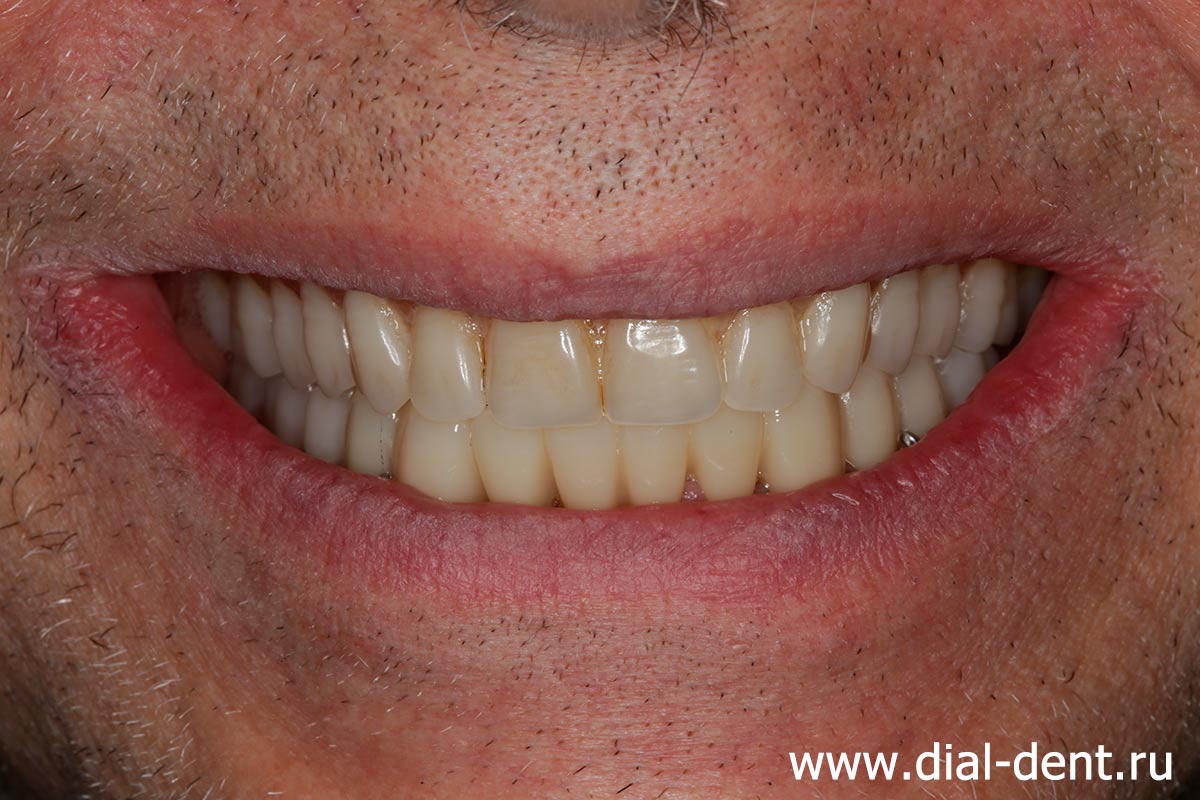 улыбка после лечения и протезирования зубов