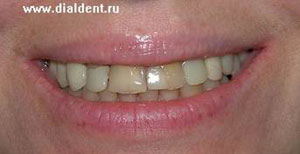 пломбы на передних зубах, желтые зубы, неровный край зубов