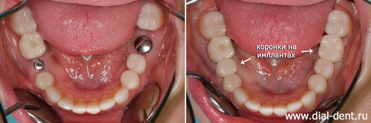 керамические коронки на имплантах взамен треснувших зубов