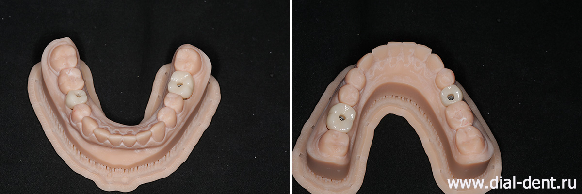 модель нижней челюсти с разных ракурсов