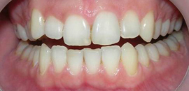 после лечения и отбеливания зуба Opalescence Xtra Boost