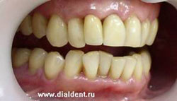 зуб восстановлен металлокерамикой, пломба в боковой зуб установлена