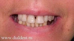 нет жевательных зубов, щель между зубами, старый протез, цвет зубов, налет