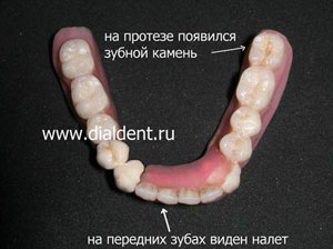зубной налет и зубной камень на съемном зубном протезе