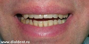 виниры на зубы - возможности эстетической стоматологии