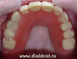 протезирование верхней челюсти нейлоновым съемным протезом в стоматологическом центре "Диал-Дент"