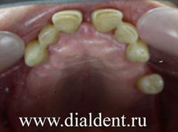 отсутствуют зубы, щель между передними зубами