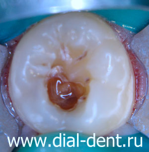 лечение кариеса - удаление размягченных тканей зуба