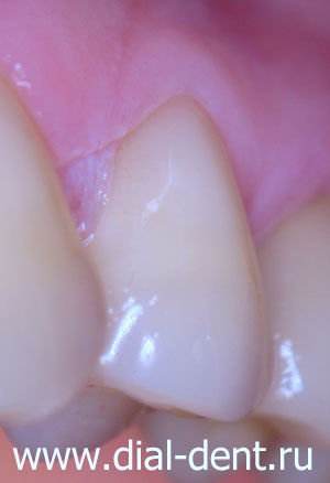 лечение некариозного поражения зубов, светоотверждаемая пломба