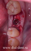 имплант зубной установлен слева