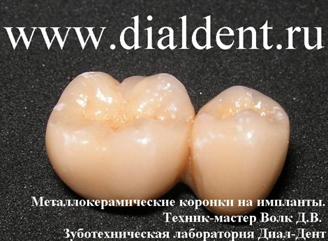 стоимость металлокерамики на имплантат 15000 рублей
