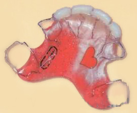 вестибулярная пластинка, с замещением передних зубов