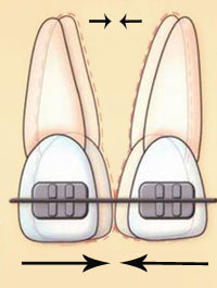корпусное перемещение зубов