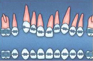 установлены брекеты для исправления положения зубов