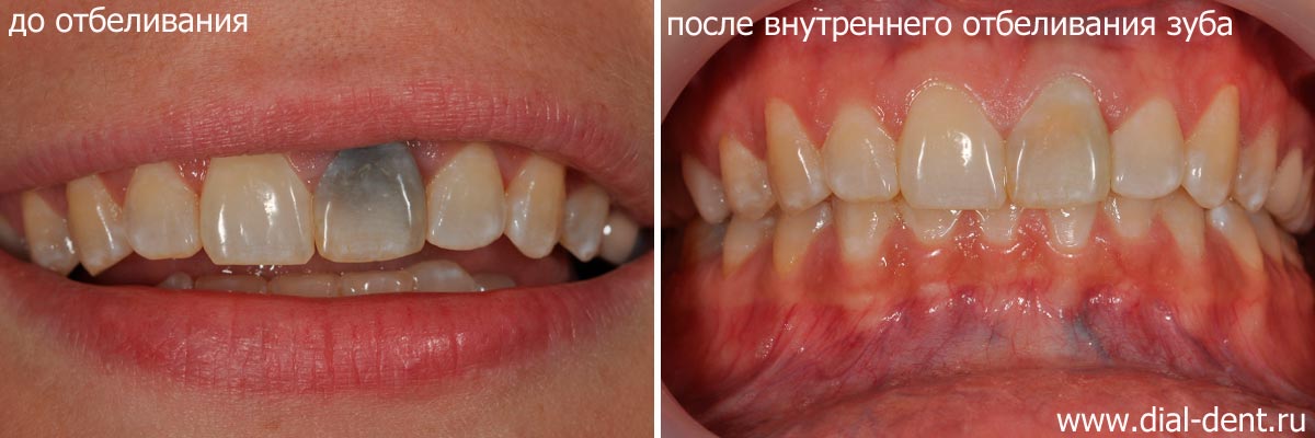 внутреннее (эндодонтическое) отбеливание зуба