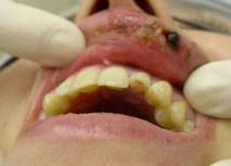 Скол части зуба с вскрытием нерва