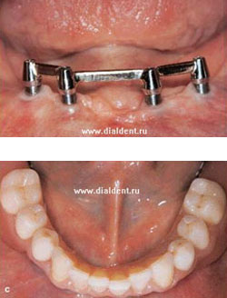 балочное крепление зубного протеза