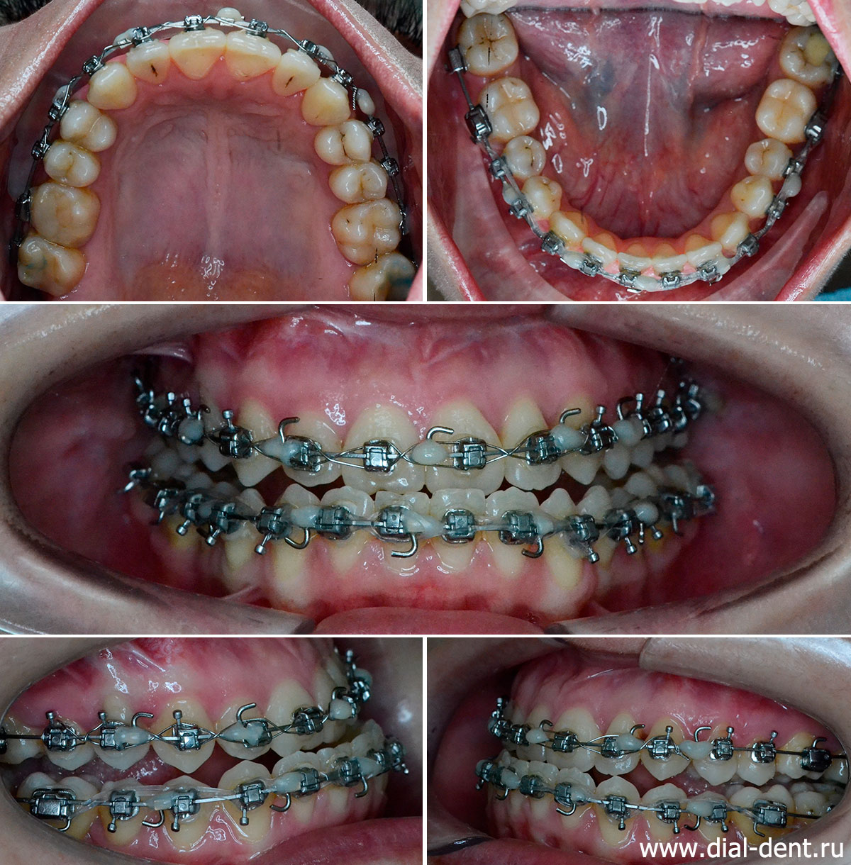 вид зубов перед второй операцией на челюстях